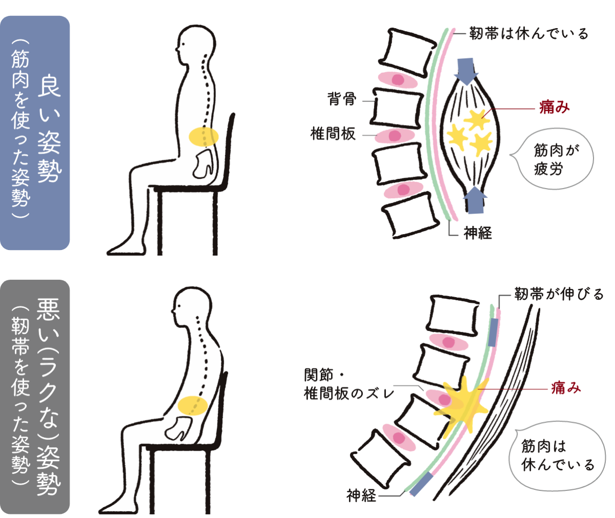 良い姿勢（筋肉を使った姿勢）背骨 椎間板 靭帯は休んでいる 痛み 筋肉が疲労 神経　悪い（ラクな）姿勢（靭帯を使った姿勢） 関節・椎間板のズレ 靭帯が伸びる 痛み 神経 筋肉は休んでいる